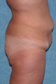 Buttock Augmentation with Circumferential Body Lift