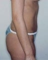 Female patient who underwent liposuction