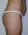 Female patient who underwent liposuction