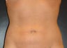 SmartLipo MPX