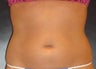 SmartLipo MPX
