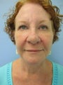 Woman, facelift and BOTOX procedure