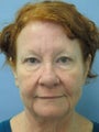 Woman, facelift and BOTOX procedure
