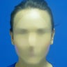 Ear Surgery (Otoplasty)