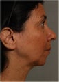 51 year old female with neck and jaw line skin laxity who wants noticeable results without invasive surgery.