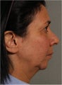 51 year old female with neck and jaw line skin laxity who wants noticeable results without invasive surgery.