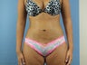 Liposuction
