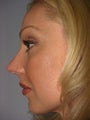 Nose Surgery (Rhinoplasty) in Boca Raton, Florida