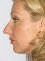 Nose Surgery (Rhinoplasty) in Boca Raton, Florida
