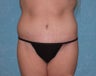Circumferential Body Lift