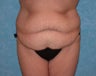 Circumferential Body Lift