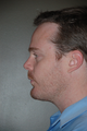 Chin Augmentation