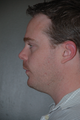 Chin Augmentation