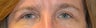 Eyelid Surgery