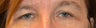 Eyelid Surgery