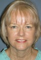 LiteLift™, Liposuction on 65-year-old Woman