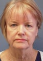LiteLift™, Liposuction on 65-year-old Woman