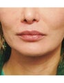 Lip Augmentation with Fat