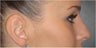 Non Sugical Nose Job