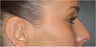 Non Sugical Nose Job