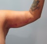 29-year-old female following massive weight loss underwent arm lift or brachioplasty procedure