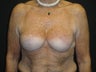 Implant-based breast reconstruction