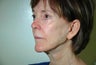Mini Face Lift