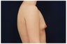 Breast Augmentation