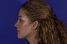 Revision Rhinoplasty