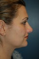 Revision Rhinoplasty