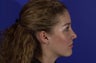 Revision Rhinoplasty