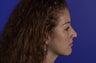 Revision Rhinoplasty
