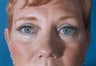 A 48-year-old female underwent Blepharoplasty
