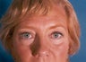 A 48-year-old female underwent Blepharoplasty