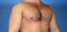 Pectoral Augmentation, Pec Implants