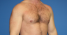 Pectoral Augmentation, Pec Implants