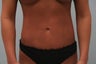 SmartLipo Abdomen and Flanks
