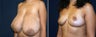 Breast Reduction