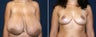 Breast Reduction