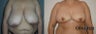 Mastopexy Breast uplift