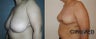 Mastopexy Breast uplift