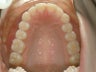Crowded teeth Invisalign treatmetn
