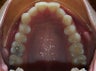 Crowded teeth Invisalign treatmetn