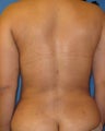 Liposuction