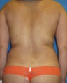 Liposuction