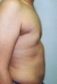 21 year old male underwent liposuction to his chest and abdominal areas