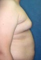 21 year old male underwent liposuction to his chest and abdominal areas