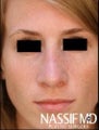 Female Primary Rhinoplasty