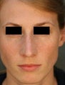 Female Primary Rhinoplasty
