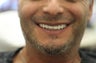All-on-4 Dental Implants